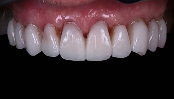 Row of teeth after 12 months with LuxaCrown