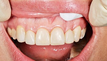 Anterior set of teeth with LuxaCrown veneer after two years