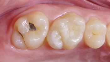 Zahnreihe vor der Behandlung