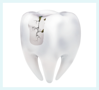 Zahnmodell ohne Mizellen