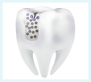 Zahnmodell mit Mizellen