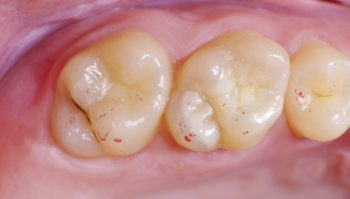 Row of teeth after treatment