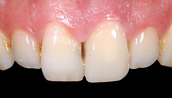 Incisor after treatment