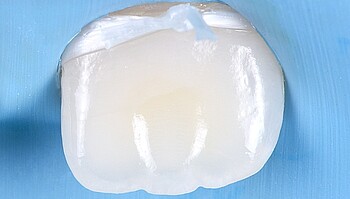 glänzender bearbeiteter Zahn ohne White Spots
