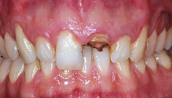 Set of teeth with defective incisor