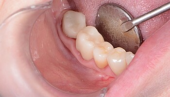 Seitenzähne vor 18 Monaten zementiert