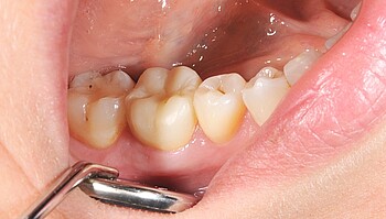 LuxaCrown crown after three years in the mouth