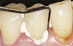 Entfernen der Zementüberschüsse am Zahn mit einer Sonde