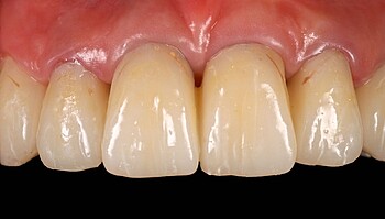 Set of teeth after 3.5 years of wearing LuxaCrown