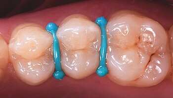 Masse zwischen Zähne