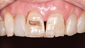 Zahnreihe vor Behandlung