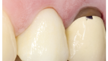 defekte Zahnreihe