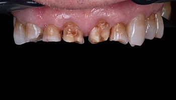 Row of teeth in a patient with bruxism