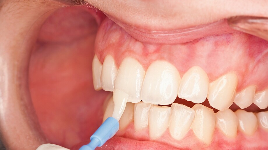 Lackieren der Zähne mit Pinsel