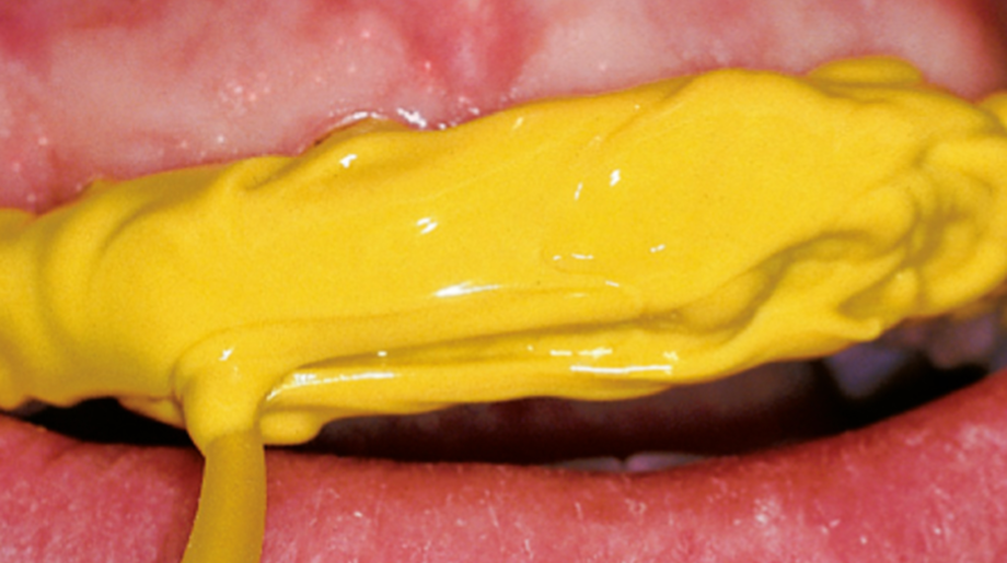 gelbe Masse auf Zähne, tropft nicht