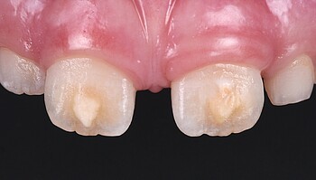 Lesions on both incisors
