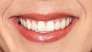 Anterior teeth after treatment