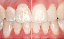 Before and after pictures with and without white spots