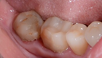 Seitenzähne vor Behandlung