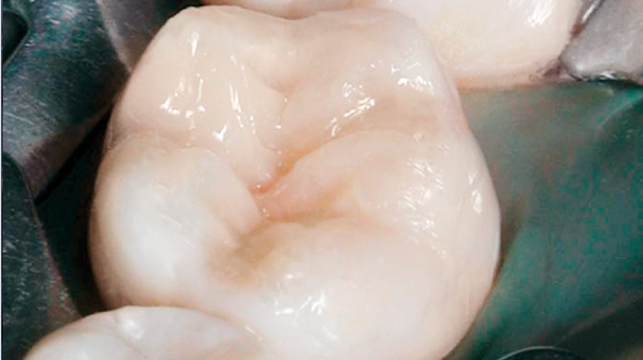 Figure: tooth filled with EcuSphere