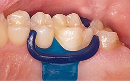 blaues Teil zwischen 2 Zähnen
