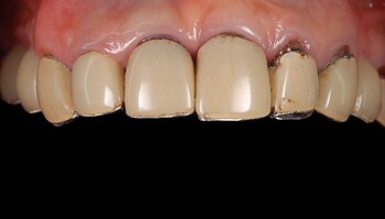 Set of teeth before treatment