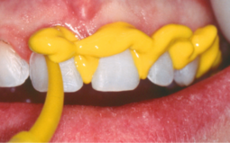 Umspritzen der Zähne mit Honigum Light