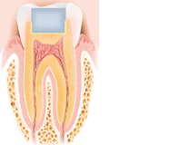 Abbildung Querschnitt Zahn
