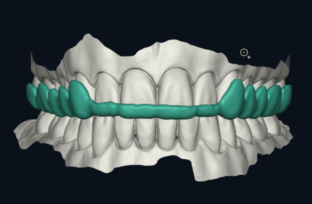 DMG Dental DentaMile connect Schiene